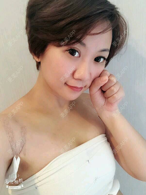 更美 - 云霞小姐姐o_o的假体隆胸日记 | 美胸套餐 | 丰胸(隆胸)