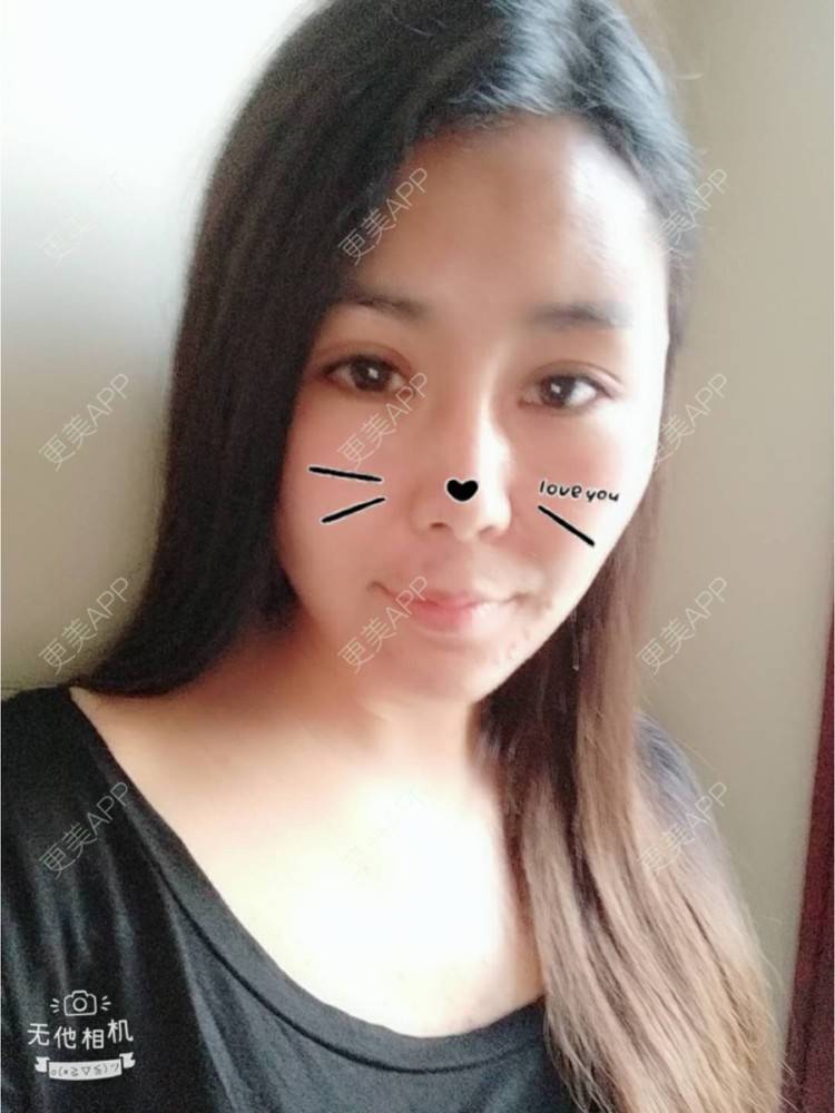 更美 - 更美用户unWeXuJrWw的玻尿酸唇部经验 | 玻尿酸唇部 | 武汉