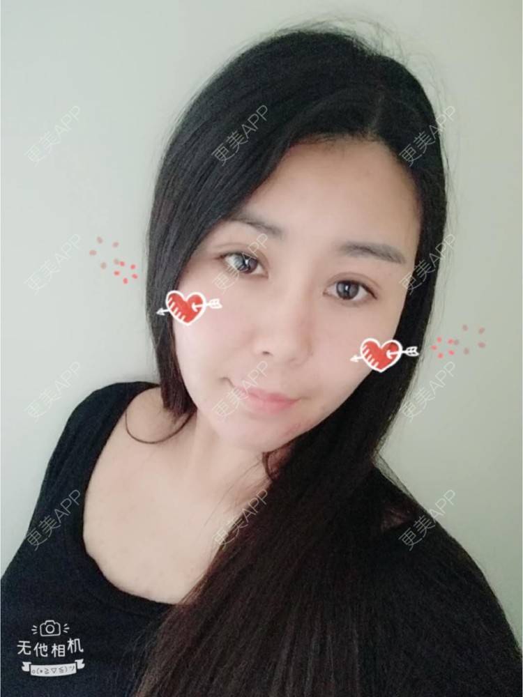 更美 - 更美用户unWeXuJrWw的玻尿酸唇部经验 | 玻尿酸唇部 | 武汉