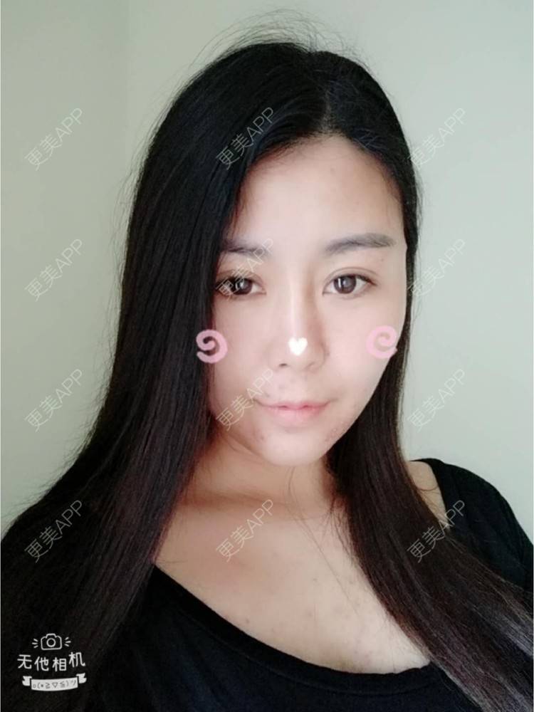 更美 - 更美用户unWeXuJrWw的玻尿酸唇部经验 | 玻尿酸唇部 | 武汉