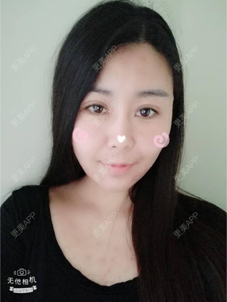 更美 - 更美用户unWeXuJrWw的玻尿酸唇部经验 | 玻尿酸唇部 | 武汉