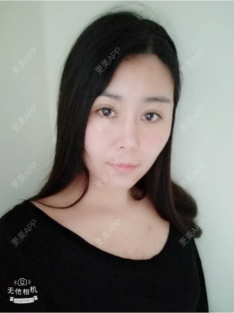 更美 - 更美用户unWeXuJrWw的玻尿酸唇部经验 | 玻尿酸唇部 | 武汉