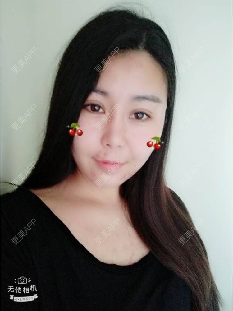 更美 - 更美用户unWeXuJrWw的玻尿酸唇部经验 | 玻尿酸唇部 | 武汉