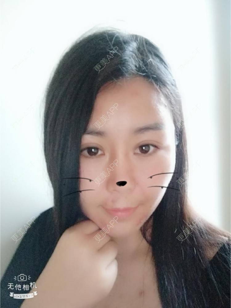 更美 - 更美用户unWeXuJrWw的玻尿酸唇部经验 | 玻尿酸唇部 | 武汉