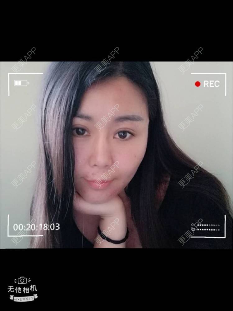 更美 - 更美用户unWeXuJrWw的玻尿酸唇部经验 | 玻尿酸唇部 | 武汉