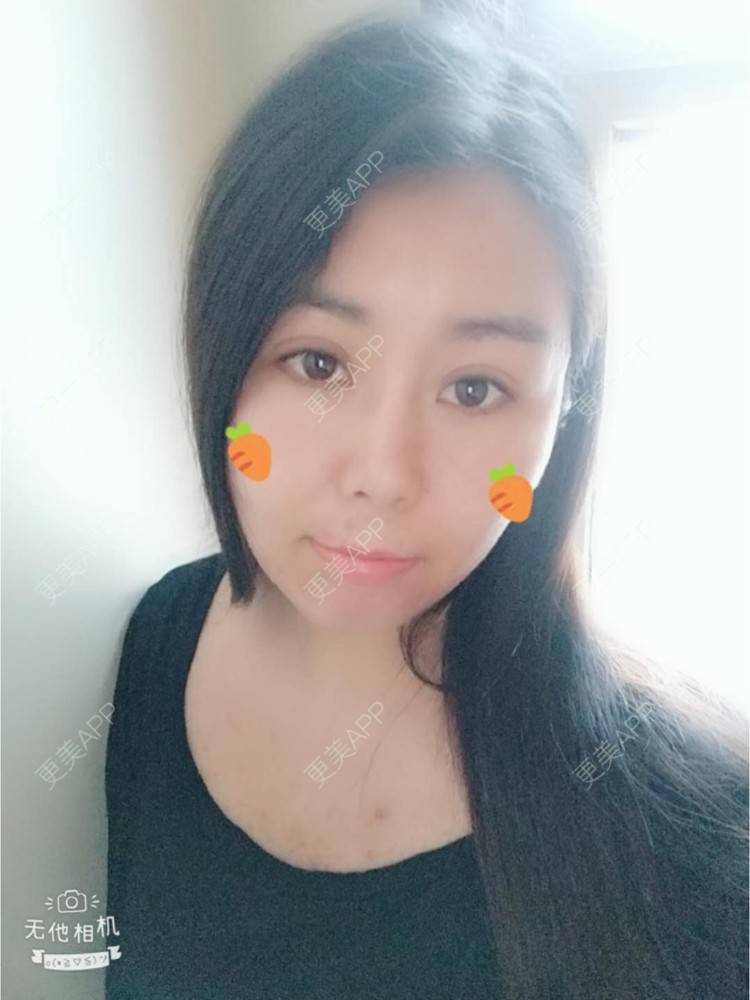 更美 - 更美用户unWeXuJrWw的玻尿酸唇部经验 | 玻尿酸唇部 | 武汉