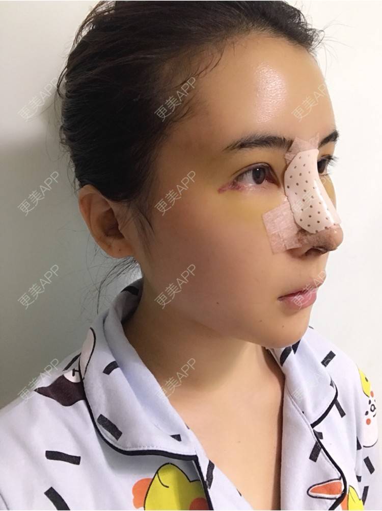 更美 - 卡卡524的自体脂肪丰额头经验 | 纳米自体脂肪面部填充 | 重庆 | 自体脂肪丰额头 | 自体脂肪填全脸