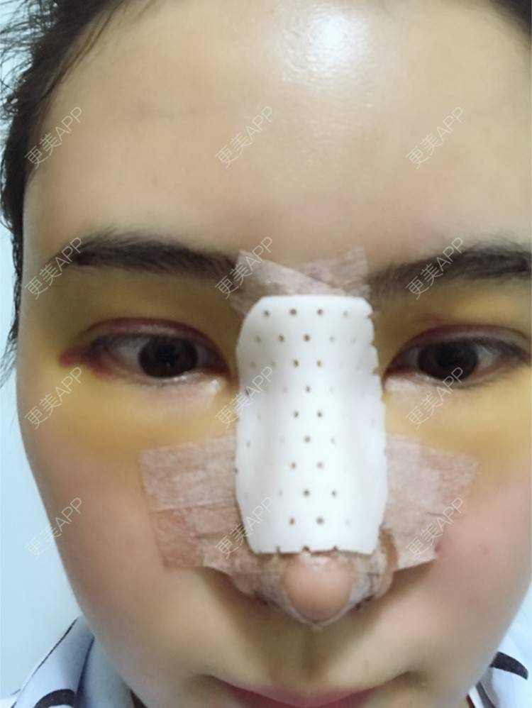 更美 - 卡卡524的自体脂肪丰额头经验 | 纳米自体脂肪面部填充 | 重庆 | 自体脂肪丰额头 | 自体脂肪填全脸