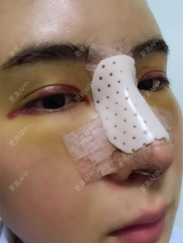 更美 - 卡卡524的自体脂肪丰额头经验 | 纳米自体脂肪面部填充 | 重庆 | 自体脂肪丰额头 | 自体脂肪填全脸