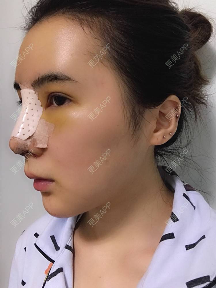 更美 - 卡卡524的自体脂肪丰额头经验 | 纳米自体脂肪面部填充 | 重庆 | 自体脂肪丰额头 | 自体脂肪填全脸