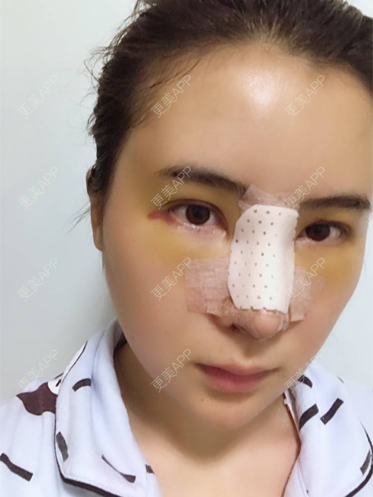更美 - 卡卡524的自体脂肪丰额头经验 | 纳米自体脂肪面部填充 | 重庆 | 自体脂肪丰额头 | 自体脂肪填全脸