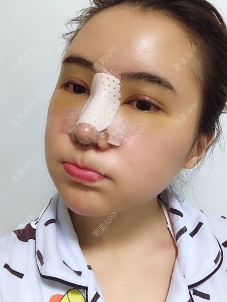 更美 - 卡卡524的自体脂肪丰额头经验 | 纳米自体脂肪面部填充 | 重庆 | 自体脂肪丰额头 | 自体脂肪填全脸