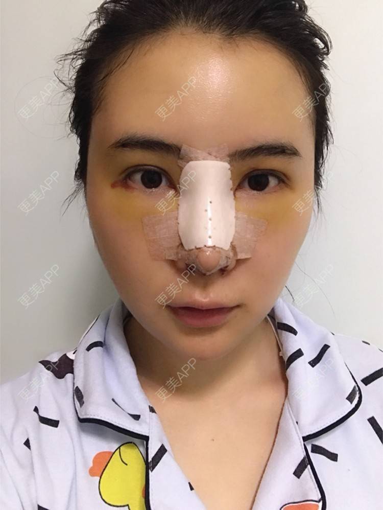 更美 - 卡卡524的自体脂肪丰额头经验 | 纳米自体脂肪面部填充 | 重庆 | 自体脂肪丰额头 | 自体脂肪填全脸