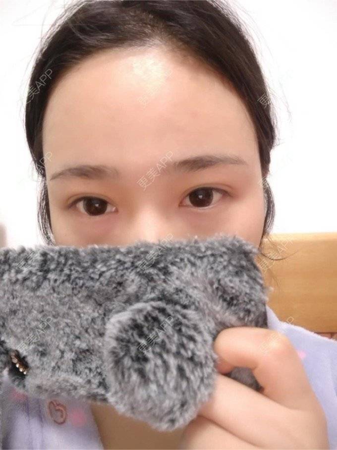 更美 - 平和哦的自体脂肪丰额头经验 | 自体脂肪丰额头 | 合肥