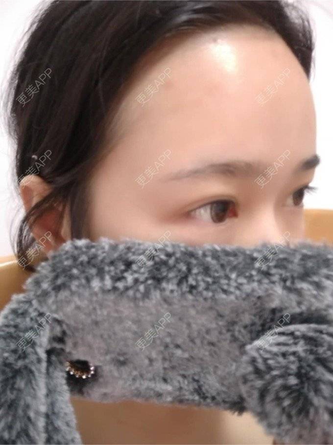 更美 - 平和哦的自体脂肪丰额头经验 | 自体脂肪丰额头 | 合肥