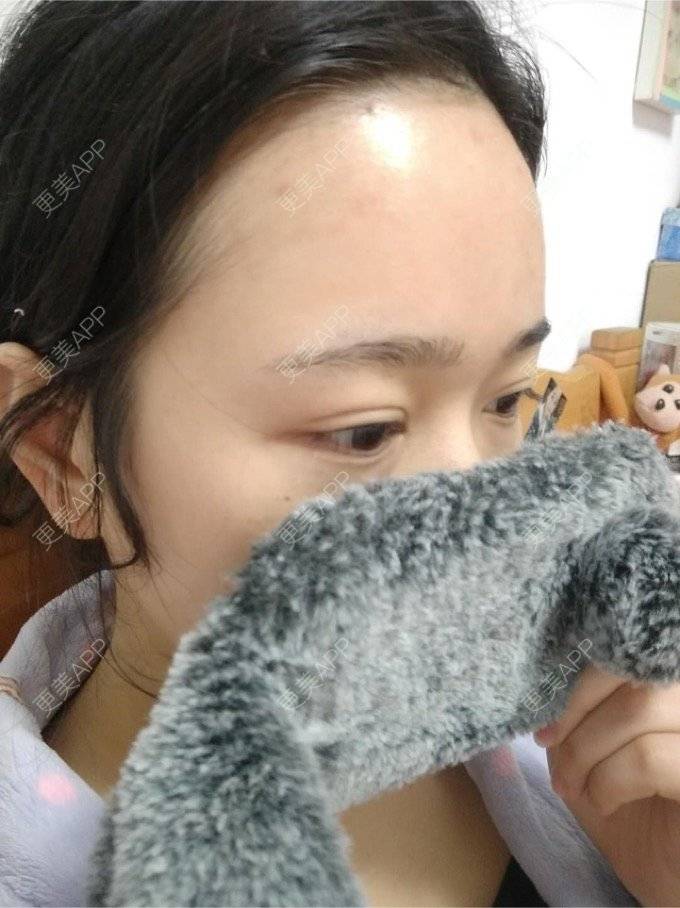 更美 - 平和哦的自体脂肪丰额头经验 | 自体脂肪丰额头 | 合肥