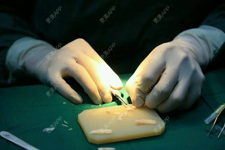 09小小萌29з的鼻部膨体假体取出日记