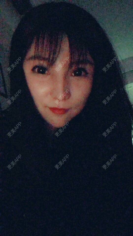 更美 - 更美用户cuJZLDzBlB的埋线提升经验 | 全脸整形套餐 | 埋线除皱 | 武汉 | 埋线提升