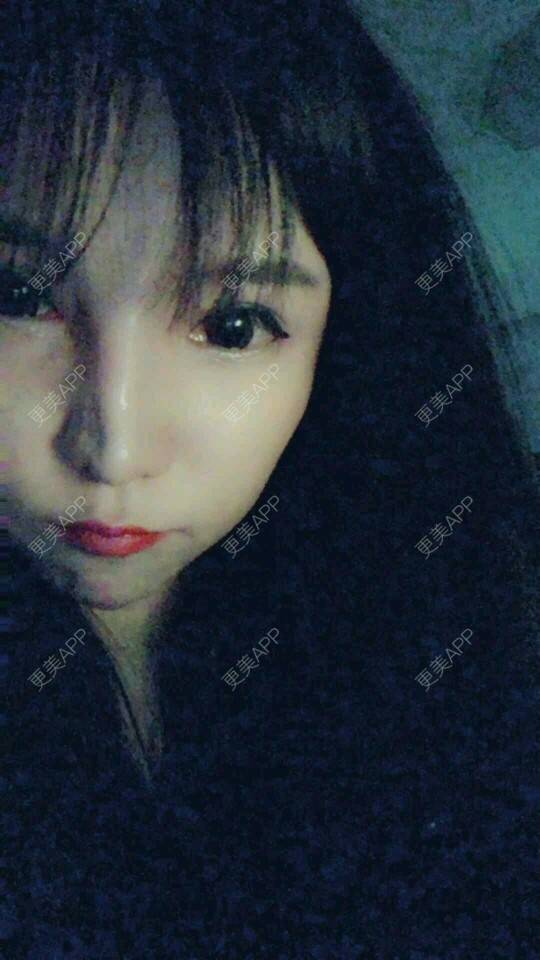 更美 - 更美用户cuJZLDzBlB的埋线提升经验 | 全脸整形套餐 | 埋线除皱 | 武汉 | 埋线提升