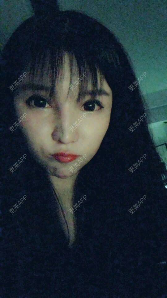 更美 - 更美用户cuJZLDzBlB的埋线提升经验 | 全脸整形套餐 | 埋线除皱 | 武汉 | 埋线提升