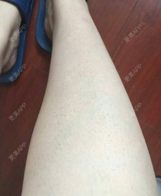 白美人的腿的激光脱毛日记