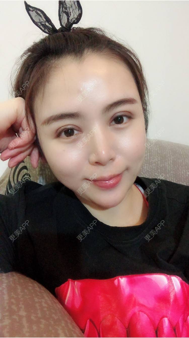 全切双眼皮效果图_rainbowli全切双眼皮效果图_术后39天__更美