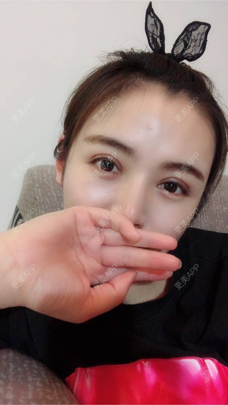 rainbowli的全切双眼皮日记