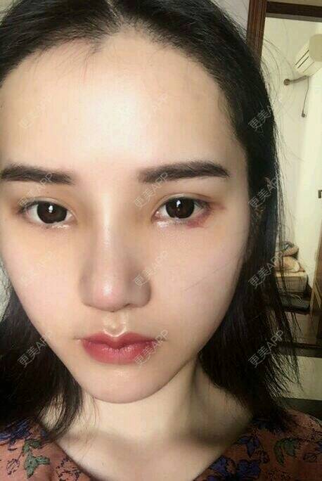 更美 - 宋宋弟弟的鼻部多项经验 | 激光紧缩阴道 | V脸套餐 | 水光项目 | 唇综合 | 隆鼻 | 鼻部多项 | 吸脂 | 注射塑形腿部 | 面部脱毛 | 激光脱毛 | 祛眼袋 | 除皱瘦脸 | 埋线提升 | 假体隆胸 | 小气泡 | 女性私密 | 广州