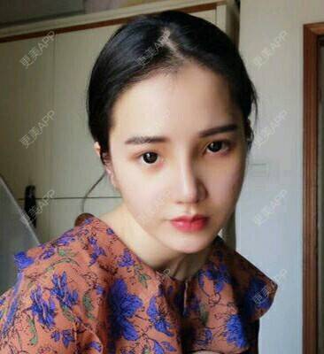 更美 - 宋宋弟弟的鼻部多项经验 | 激光紧缩阴道 | V脸套餐 | 水光项目 | 唇综合 | 隆鼻 | 鼻部多项 | 吸脂 | 注射塑形腿部 | 面部脱毛 | 激光脱毛 | 祛眼袋 | 除皱瘦脸 | 埋线提升 | 假体隆胸 | 小气泡 | 女性私密 | 广州