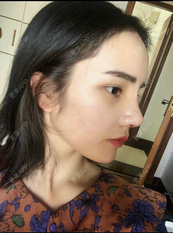 更美 - 宋宋弟弟的鼻部多项经验 | 激光紧缩阴道 | V脸套餐 | 水光项目 | 唇综合 | 隆鼻 | 鼻部多项 | 吸脂 | 注射塑形腿部 | 面部脱毛 | 激光脱毛 | 祛眼袋 | 除皱瘦脸 | 埋线提升 | 假体隆胸 | 小气泡 | 女性私密 | 广州