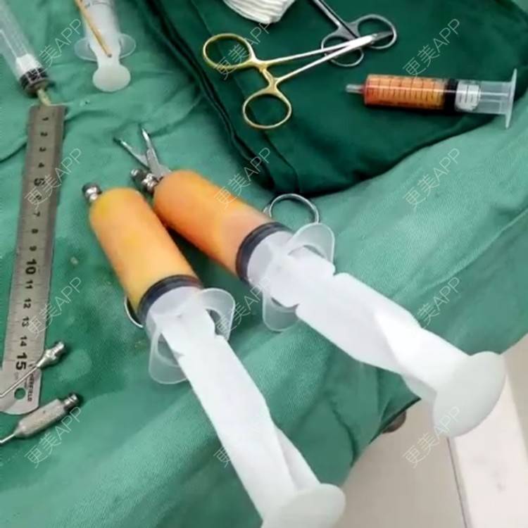 更美 - 更美用户aAcYh82bLr的自体脂肪隆胸经验 | 极速丰胸 | 自体脂肪隆胸 | 武汉 | 减肥丰胸
