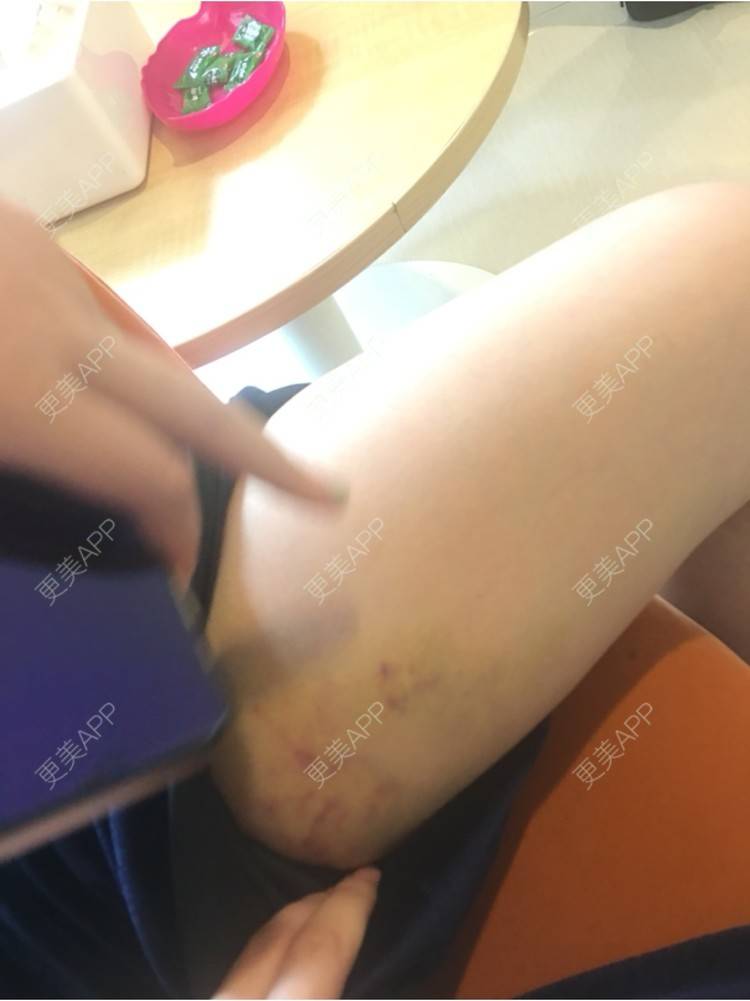 更美 - 更美用户aAcYh82bLr的自体脂肪隆胸经验 | 极速丰胸 | 自体脂肪隆胸 | 武汉 | 减肥丰胸