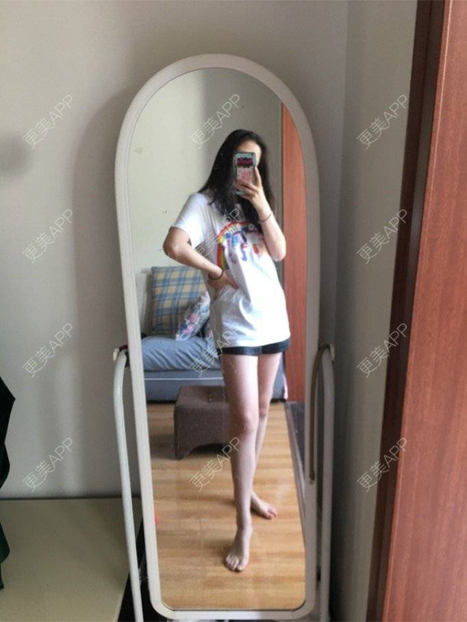 更美 - 晚清木子的吸脂经验 | 抽脂瘦腿 | 瘦身美体 | 吸脂 | 武汉