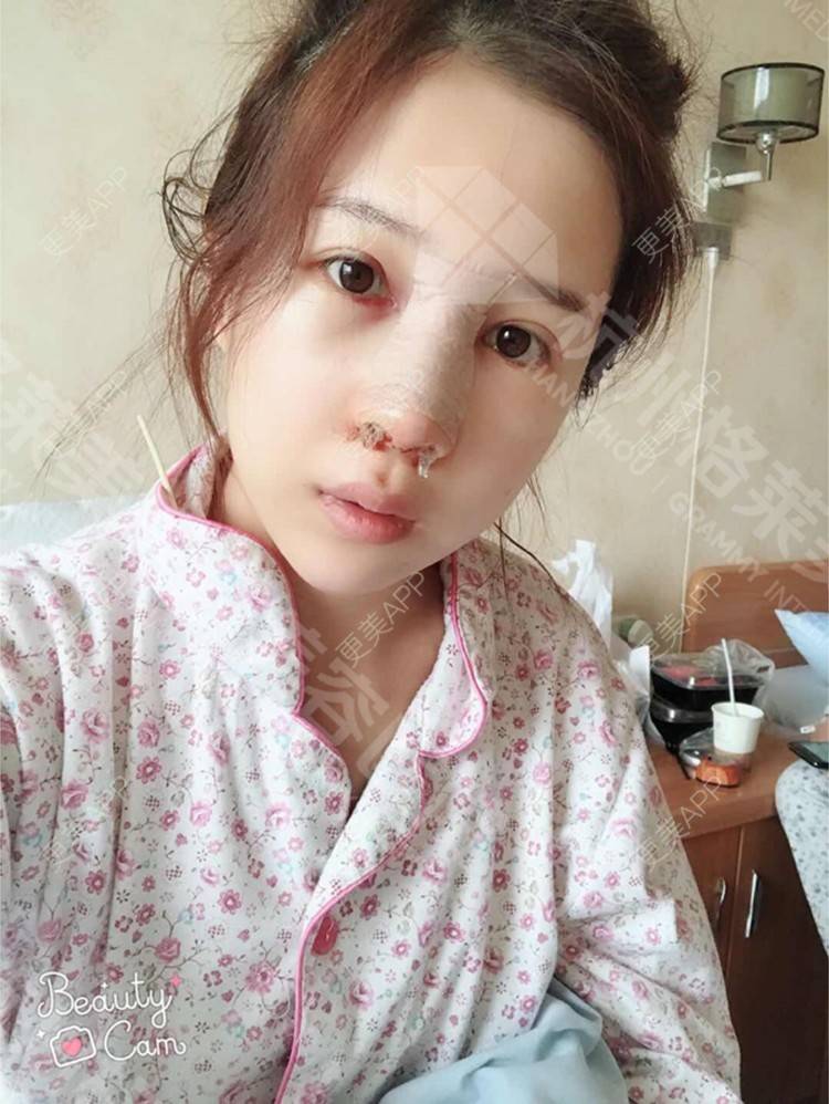 更美 - 更美用户HmkyKrDi85的肋软骨隆鼻经验 | 肋软骨隆鼻 | 假体隆鼻修复术 | 杭州