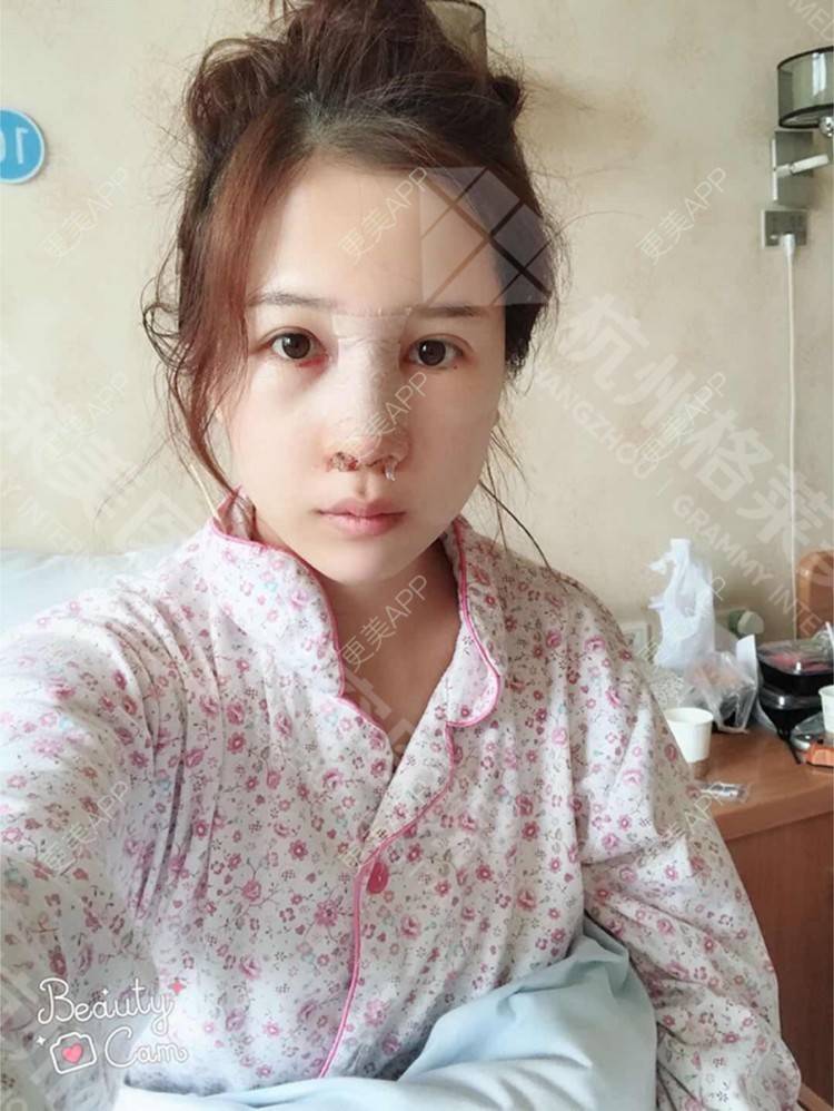 更美 - 更美用户HmkyKrDi85的肋软骨隆鼻经验 | 肋软骨隆鼻 | 假体隆鼻修复术 | 杭州