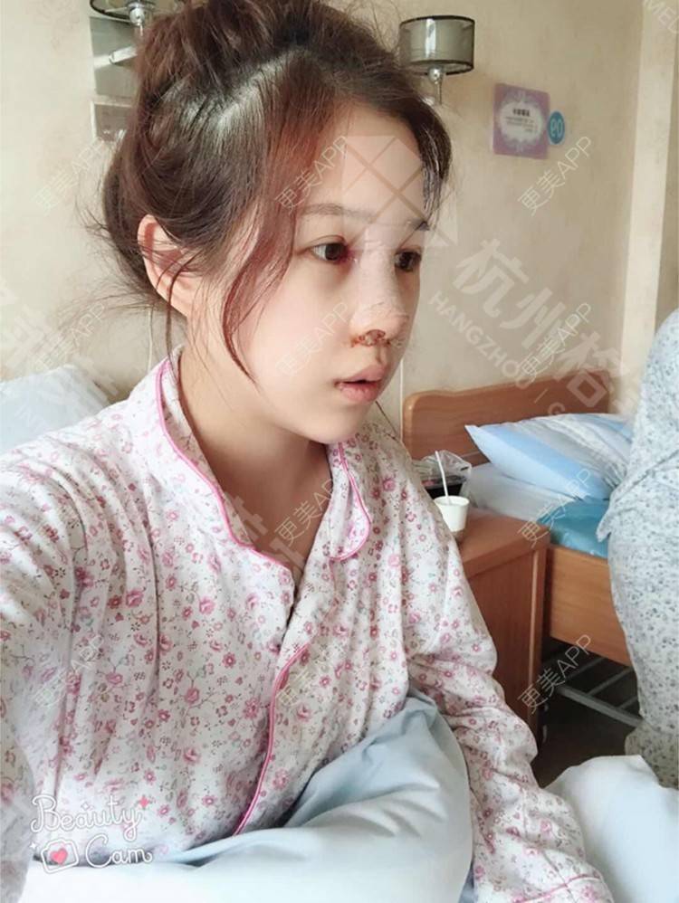 更美 - 更美用户HmkyKrDi85的肋软骨隆鼻经验 | 肋软骨隆鼻 | 假体隆鼻修复术 | 杭州