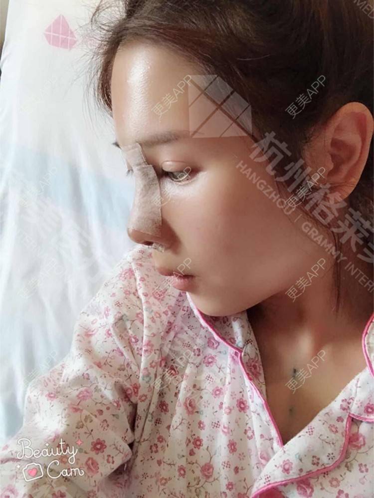 更美 - 更美用户HmkyKrDi85的肋软骨隆鼻经验 | 肋软骨隆鼻 | 假体隆鼻修复术 | 杭州