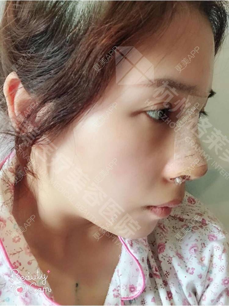 更美 - 更美用户HmkyKrDi85的肋软骨隆鼻经验 | 肋软骨隆鼻 | 假体隆鼻修复术 | 杭州