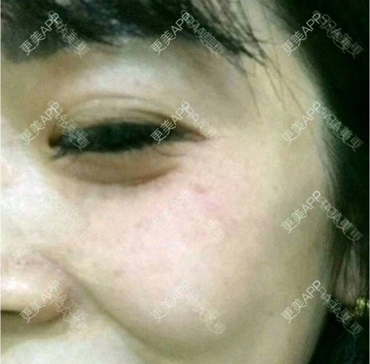 更美 - 更美用户hSW1yJzkbw的祛皱经验 | 注射除皱针打鱼尾纹 | 祛皱 | 合肥