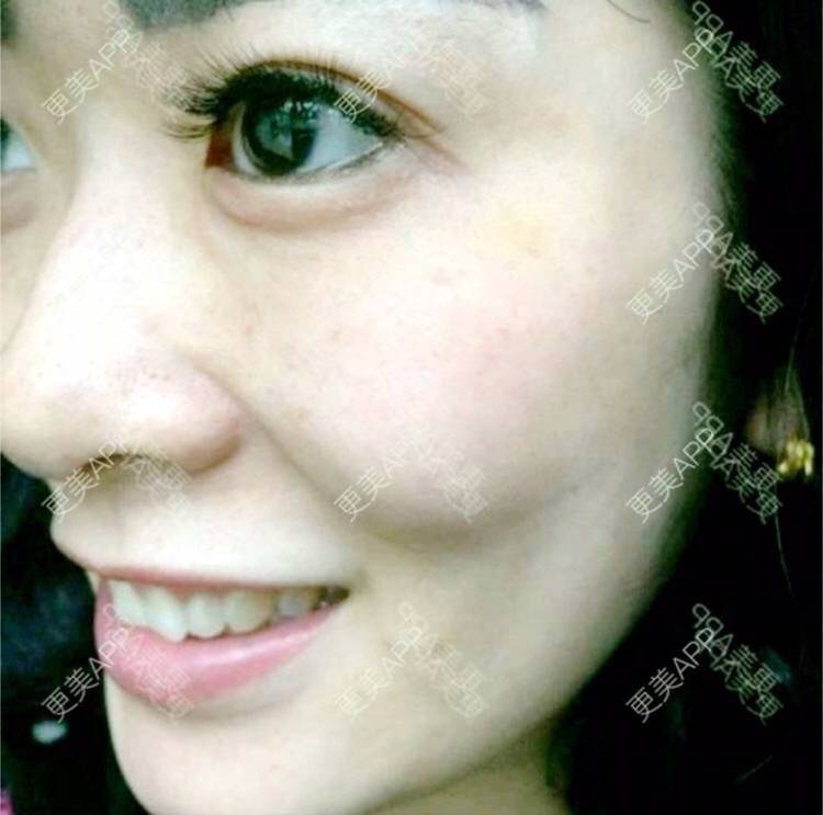 更美 - 更美用户hSW1yJzkbw的祛皱经验 | 注射除皱针打鱼尾纹 | 祛皱 | 合肥