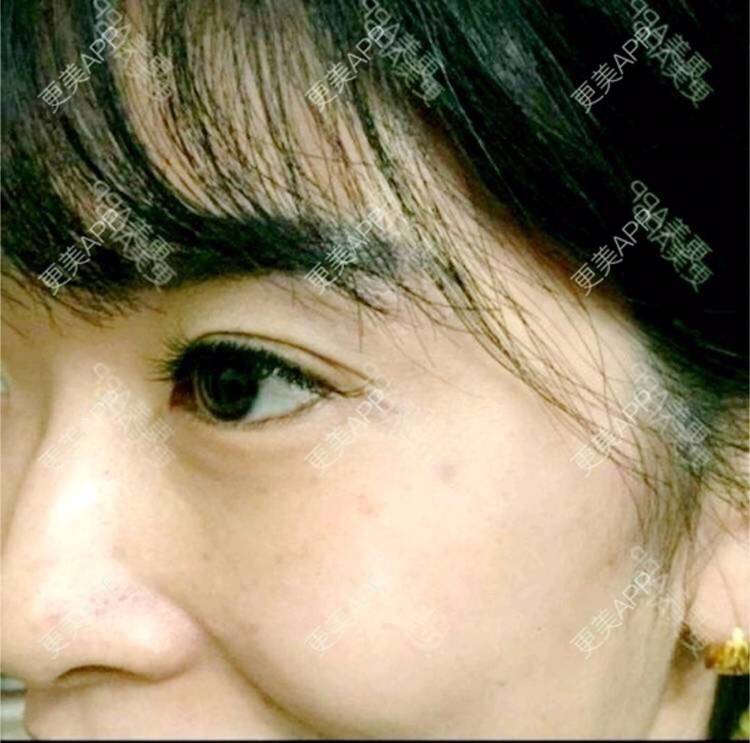 更美 - 更美用户hSW1yJzkbw的祛皱经验 | 注射除皱针打鱼尾纹 | 祛皱 | 合肥