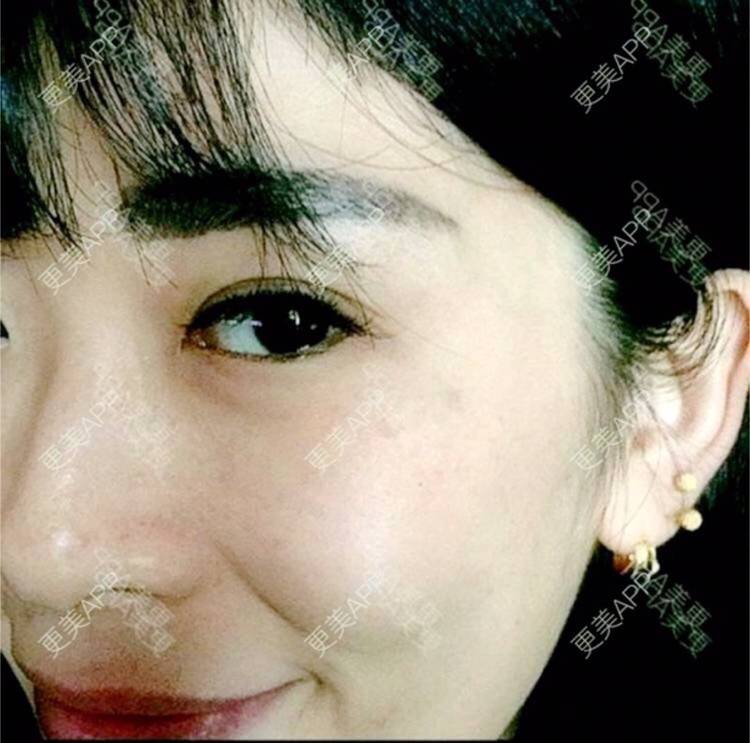 更美 - 更美用户hSW1yJzkbw的祛皱经验 | 注射除皱针打鱼尾纹 | 祛皱 | 合肥