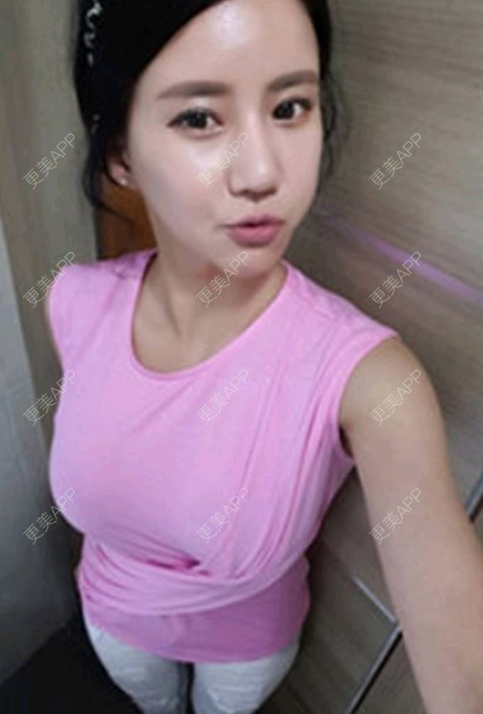 更美用户sarid6h6qu的自体脂肪隆胸日记