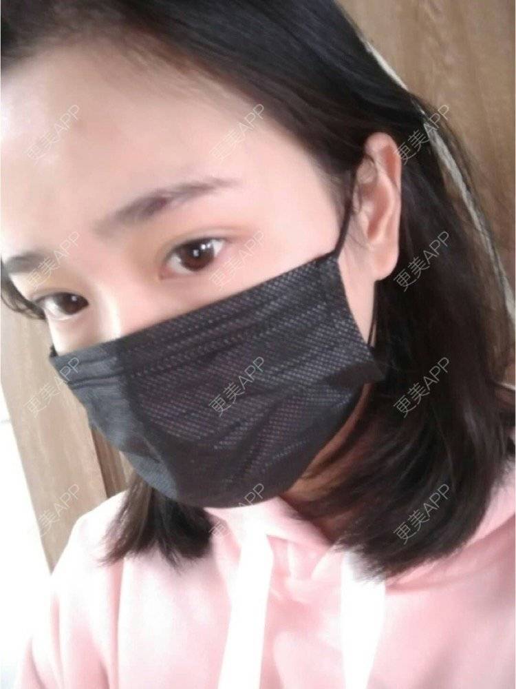 更美 - 平和哦的自体脂肪丰额头经验 | 自体脂肪丰额头 | 合肥