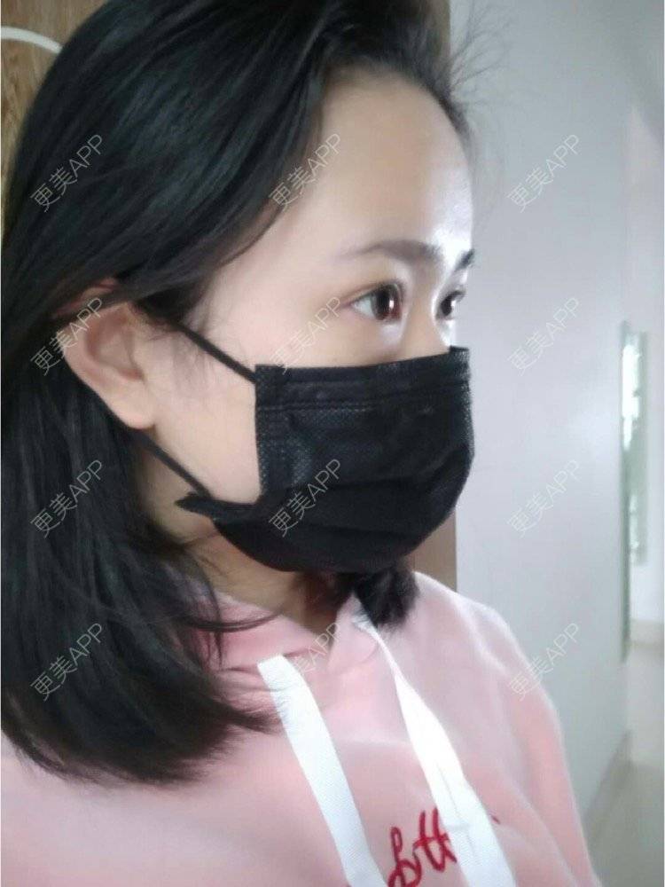 更美 - 平和哦的自体脂肪丰额头经验 | 自体脂肪丰额头 | 合肥