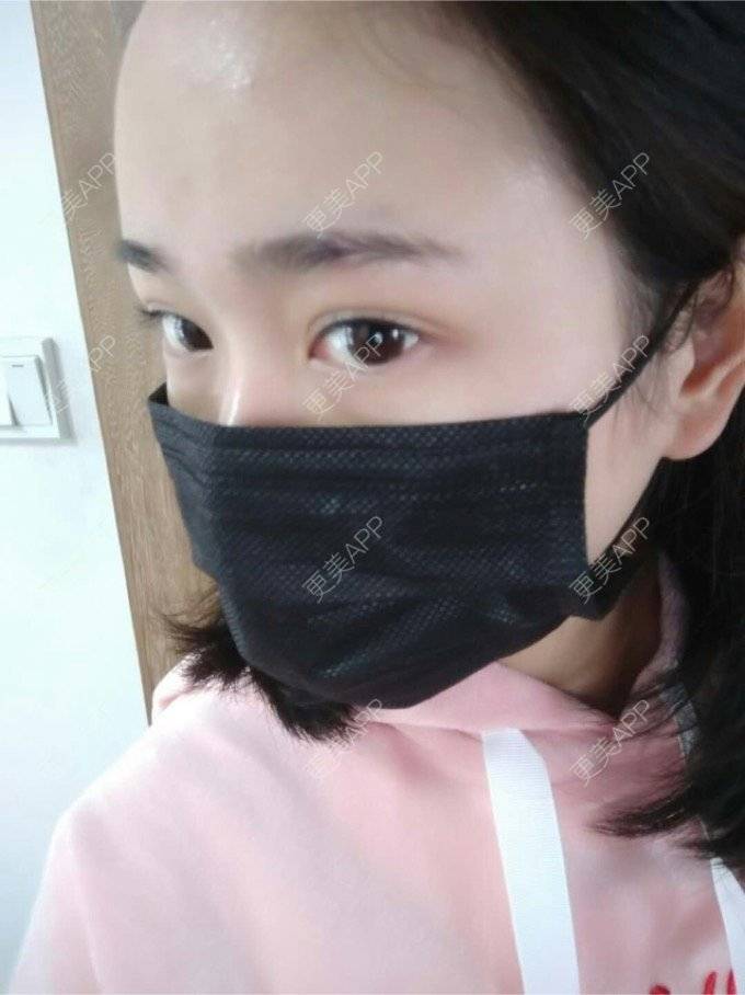 更美 - 平和哦的自体脂肪丰额头经验 | 自体脂肪丰额头 | 合肥