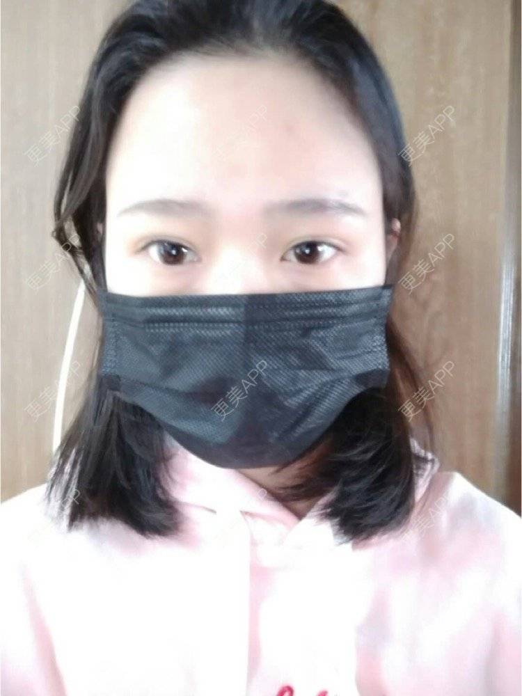 更美 - 平和哦的自体脂肪丰额头经验 | 自体脂肪丰额头 | 合肥