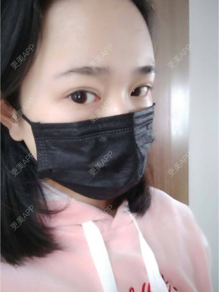 更美 - 平和哦的自体脂肪丰额头经验 | 自体脂肪丰额头 | 合肥