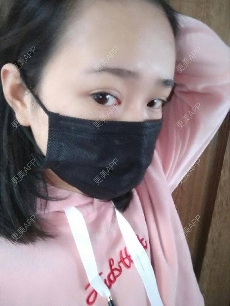 更美 - 平和哦的自体脂肪丰额头经验 | 自体脂肪丰额头 | 合肥