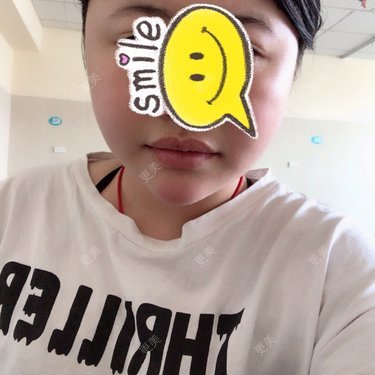吸脂瘦脸